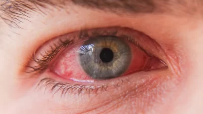 What can be the causes of conjunctiva (pink eyes)